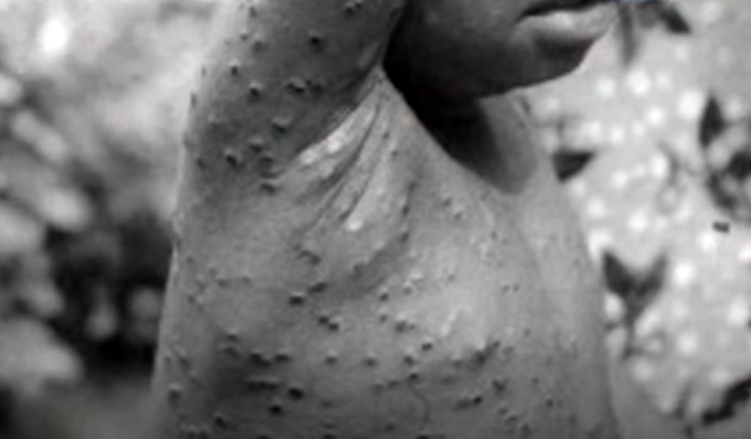 Vaiolo delle scimmie: in Lombardia salgono a 5 i casi accertati