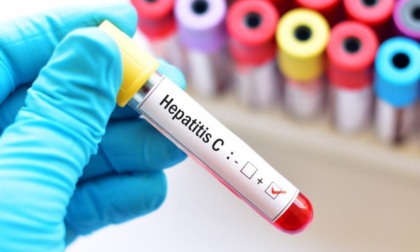 Epatite C: un semplice esame del sangue può salvare la vita. Come aderire allo screening gratuito