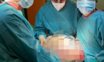 Le foto dell'operazione record all'ospedale di Crema: rimosso un tumore di 30 chili alle ovaie