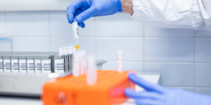 Trattamenti anticoagulanti, studio cremonese per prevenire l’ictus cerebrale
